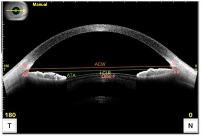 Improvement in the ideal range of vault after implantable collamer lens implantation: a new vault prediction formula